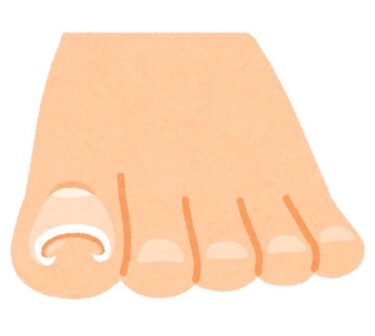 【自分でできる解消！！巻き爪】