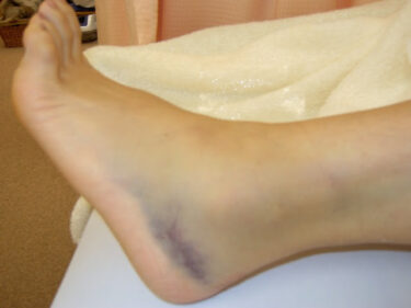 捻挫急増中！？